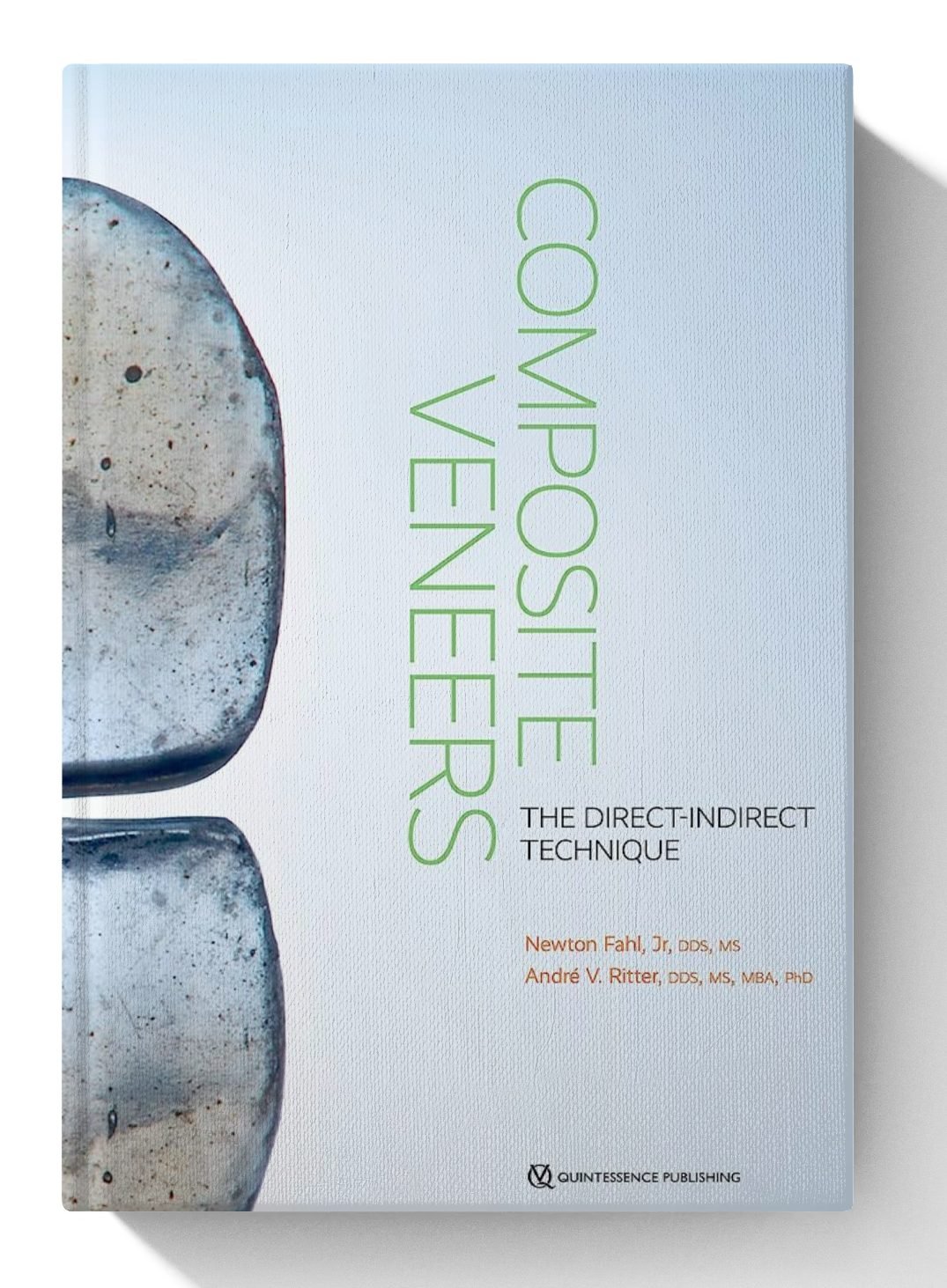 Composite Veneers: The Direct-Indirect Technique