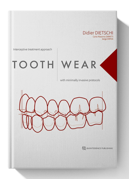 Tooth Wear: Interceptive Treatment Approach With Minimally Invasive Protocols