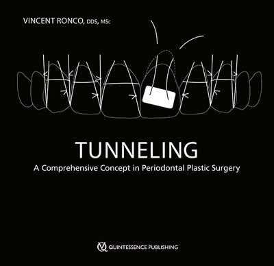 Tunneling: A Comprehensive Concept in Periodontal Plastic Surgery